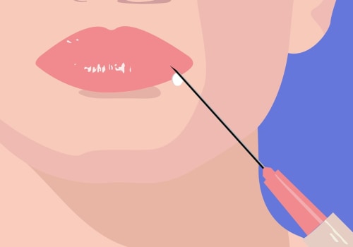 What Areas Can Be Treated with Dermal Fillers?