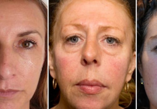 Can dermal fillers last 5 years?