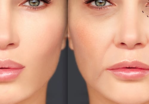 The Benefits of Dermal Fillers: A Comprehensive Guide