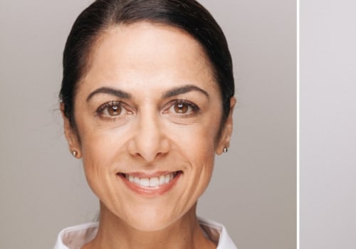 Can botox or fillers get rid of under eye bags?