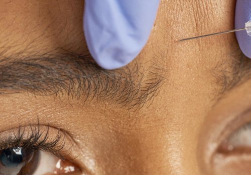 Is Filler Better Than Botox? An Expert's Perspective