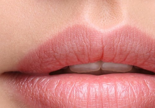 How long do dermal fillers last in Mclean, VA?