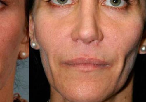 Are dermal fillers worth the cost?