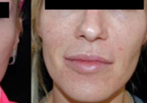 Who Can Inject Dermal Fillers? Expert Advice on Injectable Treatments