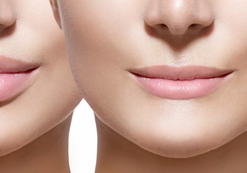 Which lip filler is right for you?